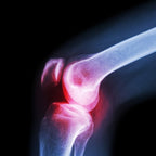 Knee Cap for Support – XL Breathable Joint Brace | Velvet Wellness