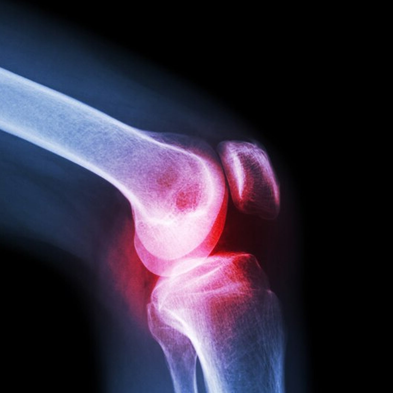 Knee Cap for Support – Large Size for Joint Relief | Velvet Wellness