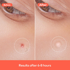 Pimple Patches Hydrocolloid & Tea Tree Oil for Acne | GlowForm - Detail View 7