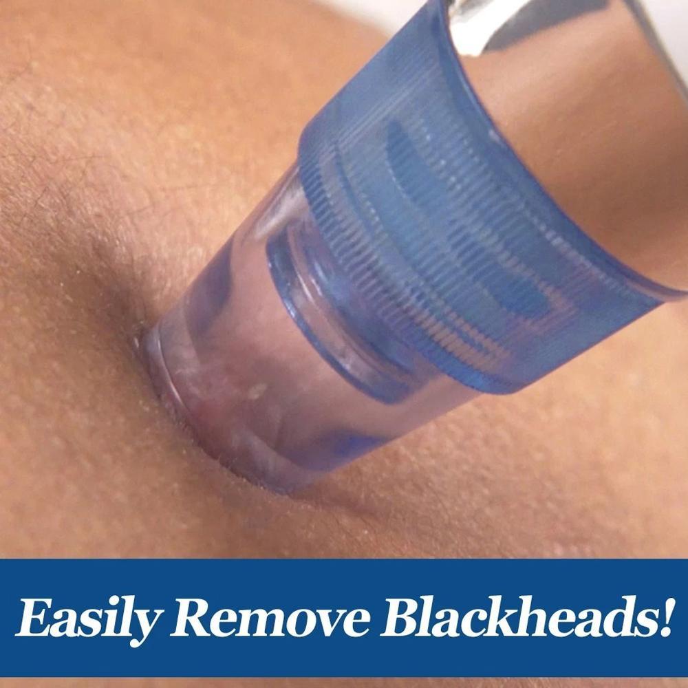  Blackhead Remover – 4-in-1 Vacuum Suction Pore Cleaner | ALVENZA - Detail 5